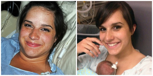 Left pic: Tricia's face at the time her labor was induced. Right pic: 5 days later the edema was completely gone.